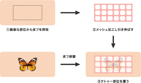 ①健康な部位から皮フを搾取 ②メッシュ加工し引き伸ばす 皮フ剥離 ③タトゥー部位を覆う