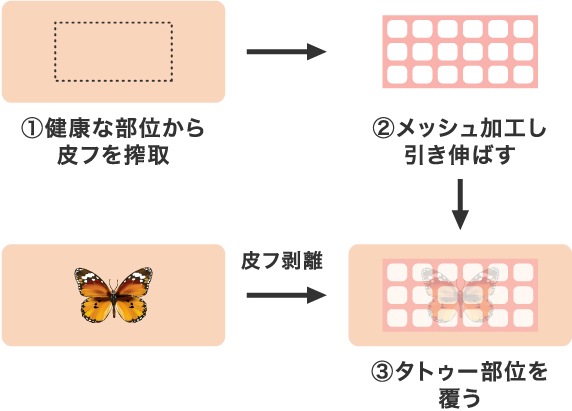 ①健康な部位から皮フを搾取 ②メッシュ加工し引き伸ばす 皮フ剥離 ③タトゥー部位を覆う