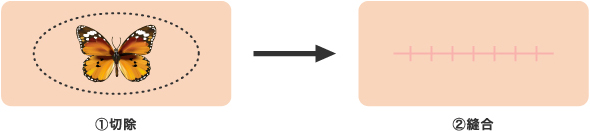 ①切除 ②縫合