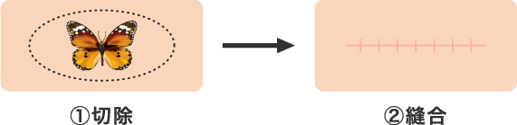 ①切除 ②縫合